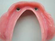 Caution: When using the Retainer, add about 2 mm to the height of the Retainer with putty to ensure