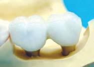 Accordingly, a load on the implant crown or bridge directly affects the bone, possibly