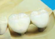 longer shaft of the implant and antagonist teeth should be attempted as much as possible.