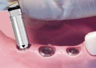 2 Hex torque driver for Solid abutment: wide Short Long Separate the Cover screw or Healing abutment using a 1.