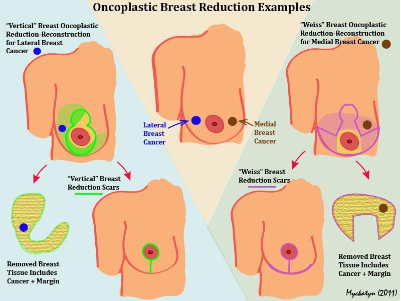 BCT and Partial Breast Reconstruction Displacement Techniques Parenchymal remodeling Achieved via mastopexy and