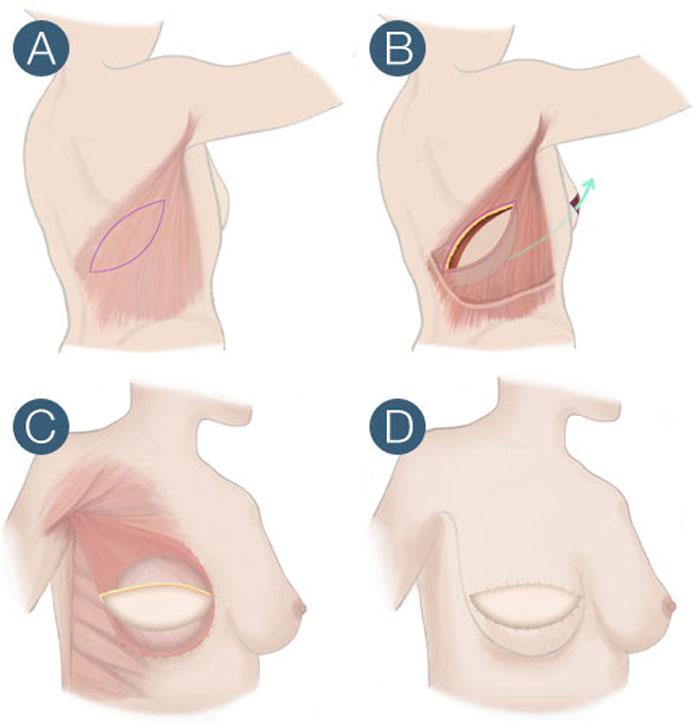 Latissimus dorsi myocutaneous flap Can be performed as part of volume replacement technique after BCT totally autologous breast reconstruction in conjunction with breast implant Contraindications: