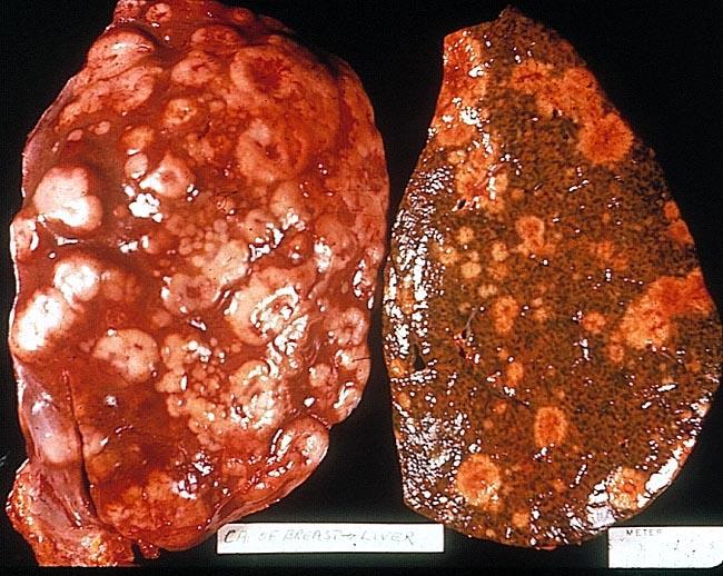 Clinical Liver Metastases http://www.pathology.