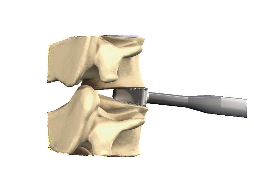 elements. Step 2: Creating Disc Space Access Patient is placed in the supine position. The anterior cervical spine is exposed via the standard surgical approach.
