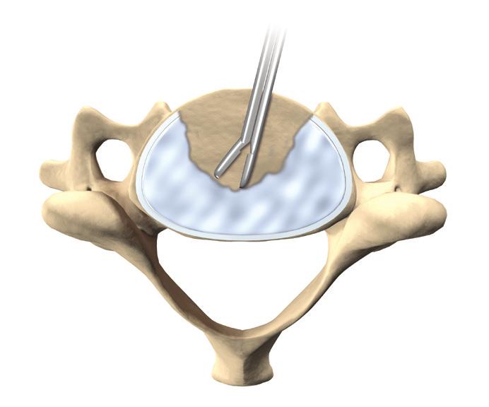Using the Rasp end of the Double Ended Trial/Rasp for the estimated device height, scrape the cartilaginous layers from the surface of the adjacent vertebral end plates