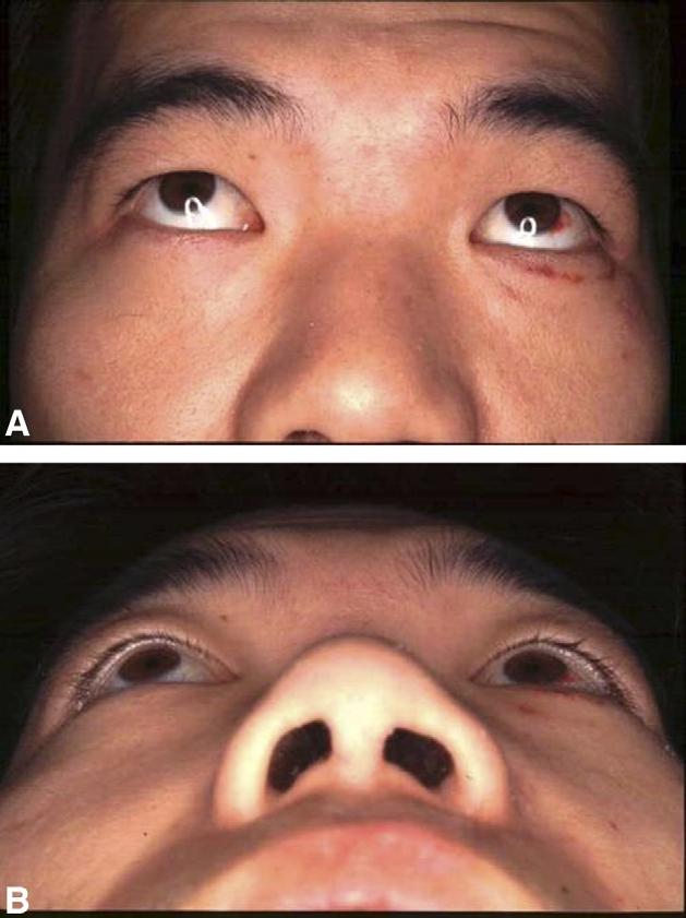 40 M. Kakibuchi et al. of it was inflated to support the repaired orbital floor. The position and movement of the eyeball were improved and the double vision disappeared (Fig. 7).