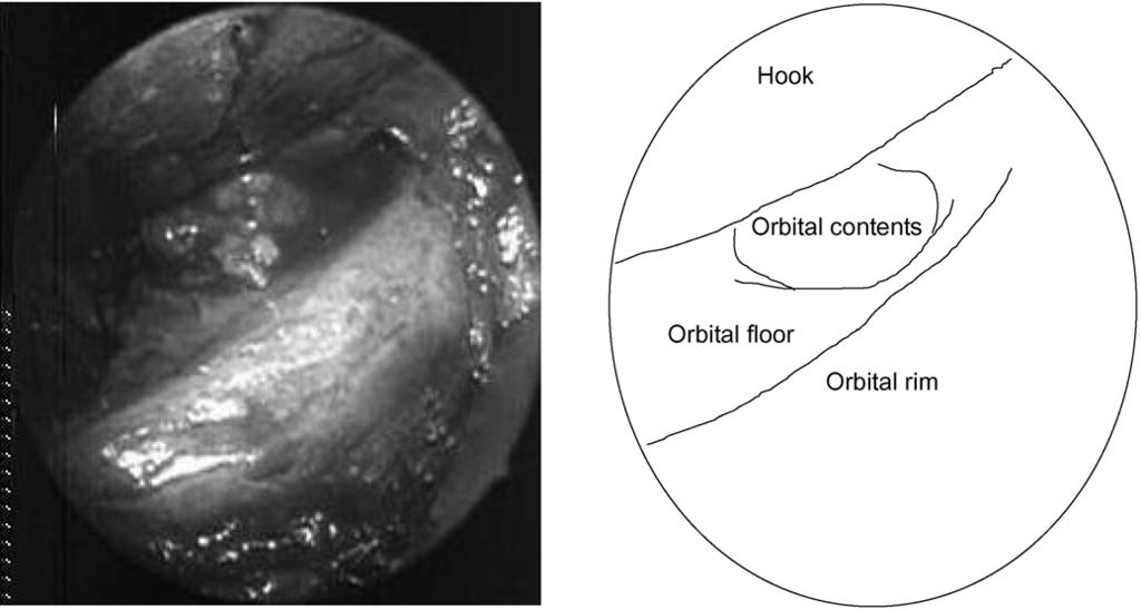 Even in this era of sophisticated computerised tomography and magnetic resonance imaging, insufficient preoperative information about the condition of the damaged orbital floor and herniated orbital