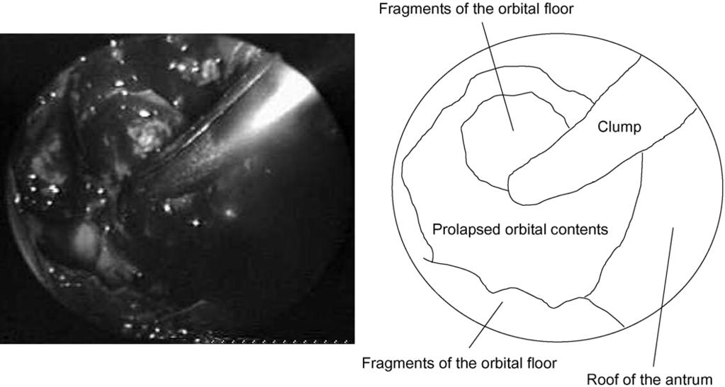42 M. Kakibuchi et al. Figure 5 Endoscopic findings of the roof of the antrum. Reduction of the orbital contents is assisted with clump through the ostium.