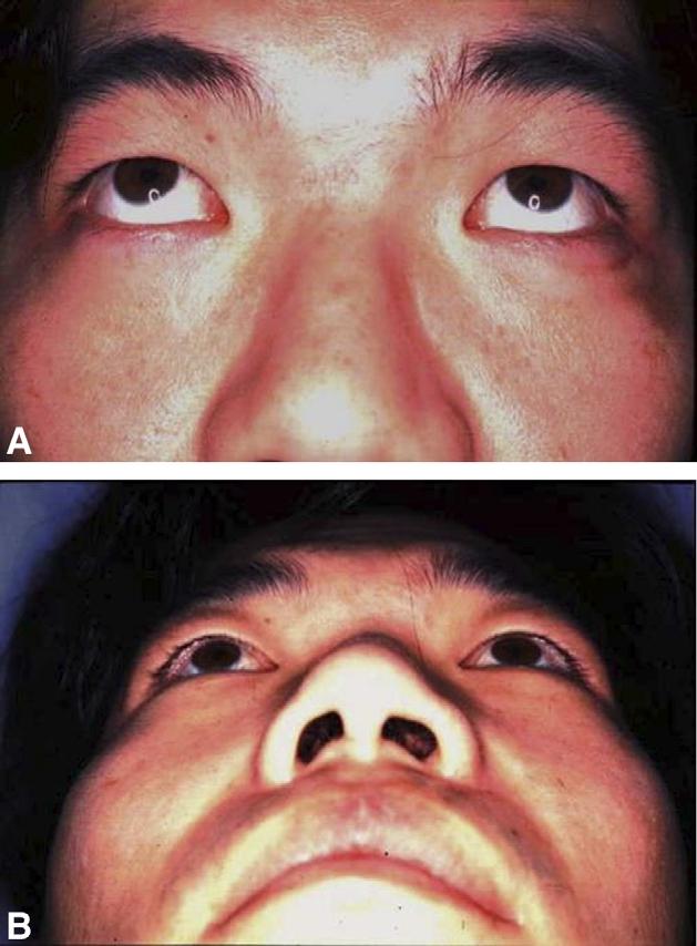 Combination of transconjunctival and endonasal-transantral approach 43 enhances accuracy in reduction of the orbital contents and reconstruction of the orbital floor.