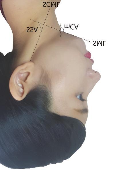 mc: measured cervical angle; SS: submental-sternocleidomastoid angle; SML: submental line; SCML: sternocleidomastoid line (anterior border of SCM) Figure 2: Operative technique.