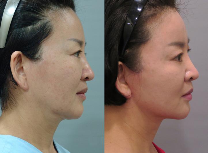 Figure 5: Preoperative () and postoperative 3 years () photographs of a 64-year-old woman who had elastic face lift and neck lift with skin excision Figure 6: Preoperative () and postoperative 2