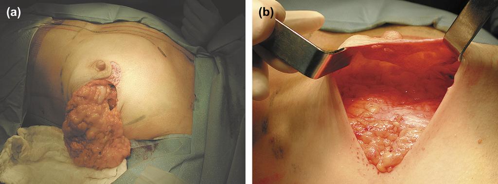 1234 H.D. Loustau et al. Figure 1 Mastectomy. (a) The subcutaneous mastectomy is completed. (b) Preserving a good thickness of the subcutaneous fat.