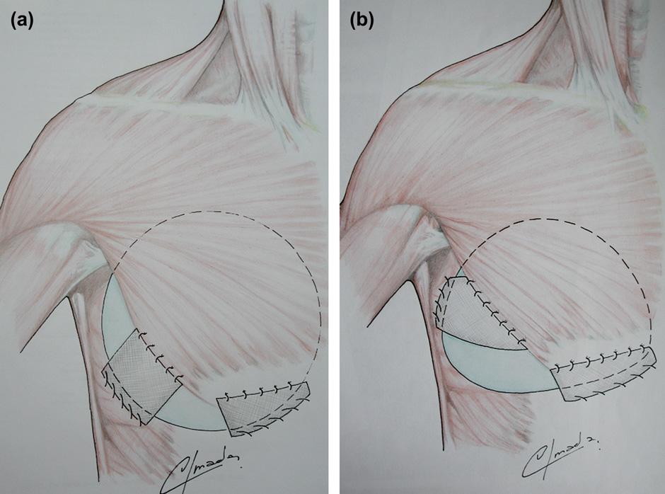 Immediate prosthetic breast reconstruction 1235 also important to preserve the anatomical continuity between the pectoralis major and the rectus abdominis sheath.
