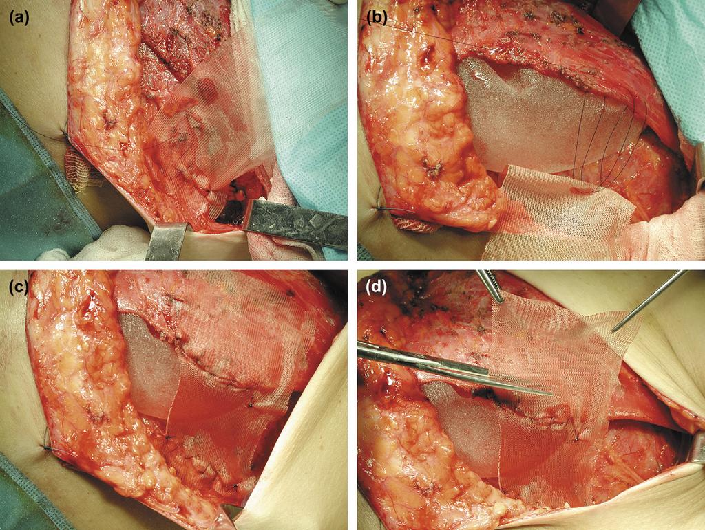 1236 H.D. Loustau et al. Figure 4 Sequence of mesh fixation. (a) The mesh is sutured by its distal extremity to the serratus anterior muscle at the level of the pocket s boundaries.