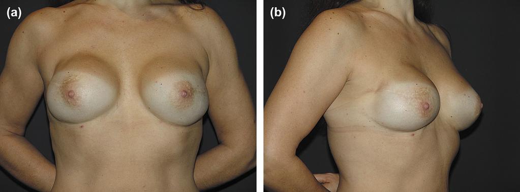 Immediate prosthetic breast reconstruction 1237 Figure 7 Risk-reducing mastectomy and bilateral IPBR through the ESP technique with an anatomical implant.