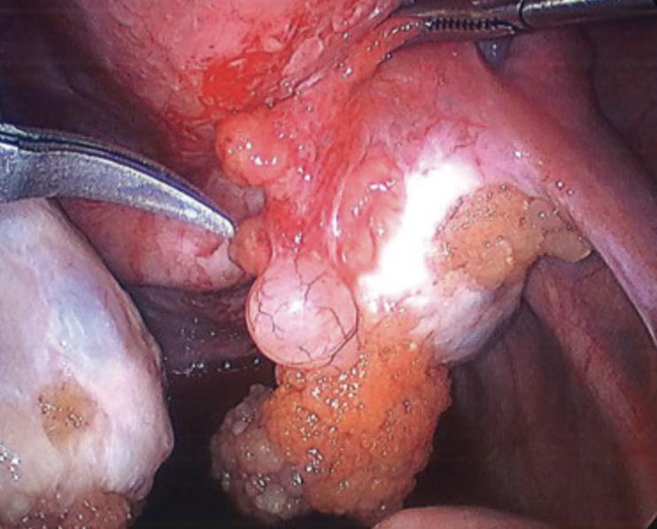 There is no evidence-based indication for cytotoxic chemotherapy (Faluyi 2010) Appendix 1 clinical intraoperative images of abnormal ovaries consistent with borderline tumour of the ovary.