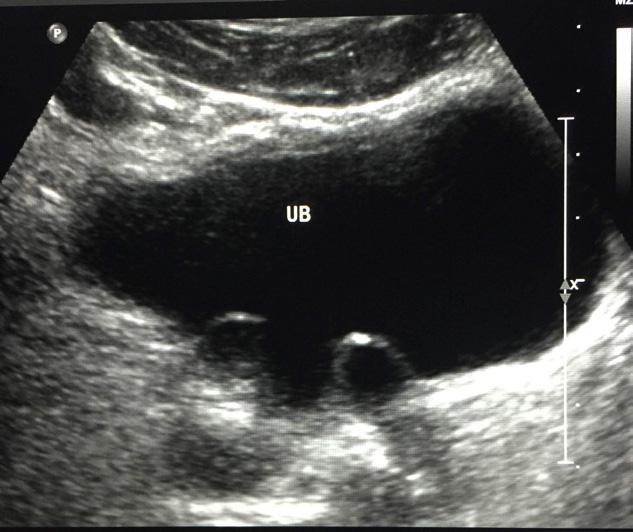 Patient presented to his family physician complaining of acute recurrent epigastric pain or discomfort of 2 weeks duration, his primary clinical assessment and abdominal ultrasonography reported.