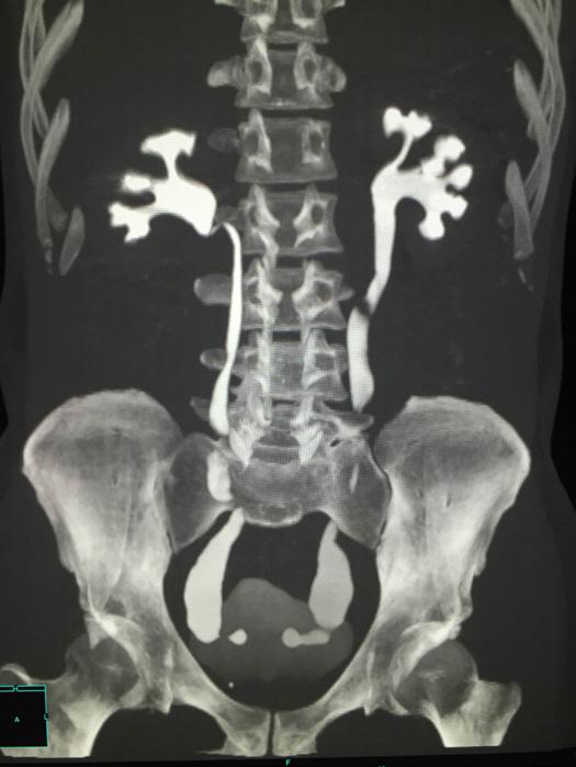 Fig.4: CT urogram revealed bilateral hydroureteronephrosis, bilateral saccular collection of contrast with a halo of lucency surrounding it (Cobra head sign