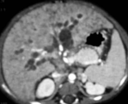 a b c d Figure 1. a e. Axial MDCT images in portal phase (a, b) show multiple biliary cysts along portal tracts (the largest measuring 1.