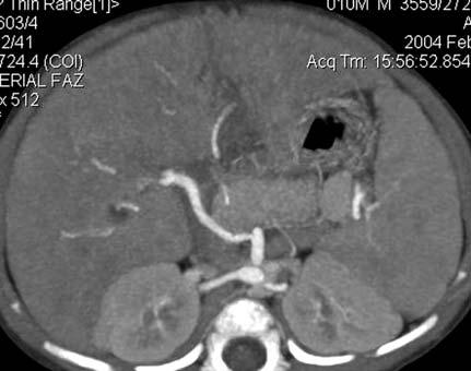 original magnification). e Imaging evaluation All CT examinations included in the study were obtained within a onemonth period before liver transplantation.