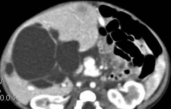1-month-old patient. The hyperdense material was 32 HU in precontrast images (not shown). The patient died due to intraabdominal hemorrhage after cystojejunostomy procedure. or caudate lobe (27.