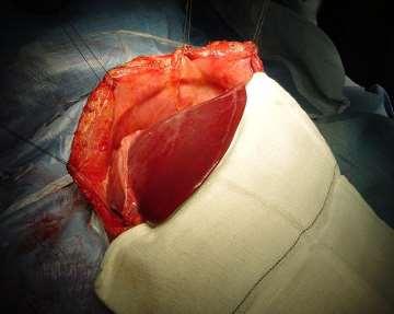 The left portion (so-called left lobe) of the adult donor