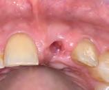 Under local anesthesia, the nonrestorable tooth was atraumatically extracted without raising a flap.
