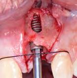 76 8a and b I Placement of the Paltop Advanced Plus implant.