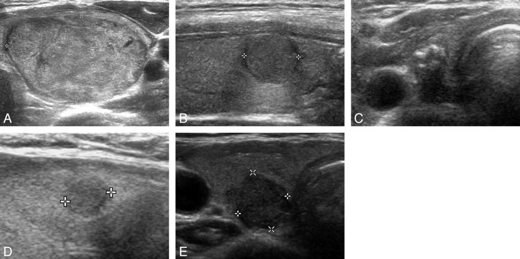 Fig 2. The 5 US categories for solid Bethesda class III nodules. A, Benign: transverse US image of a left thyroid nodule (approximately 2.7 4.2 5.