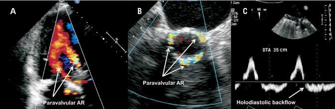 Echocardiography for PVL assessment European Journal of
