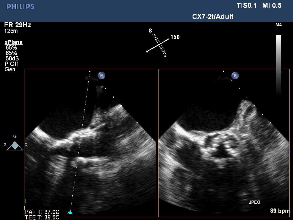Echocardiography for PVL assessment Readily available transthoracic (compatible with minimalist TAVR approach) Views somewhat limited while patient on supine position May need