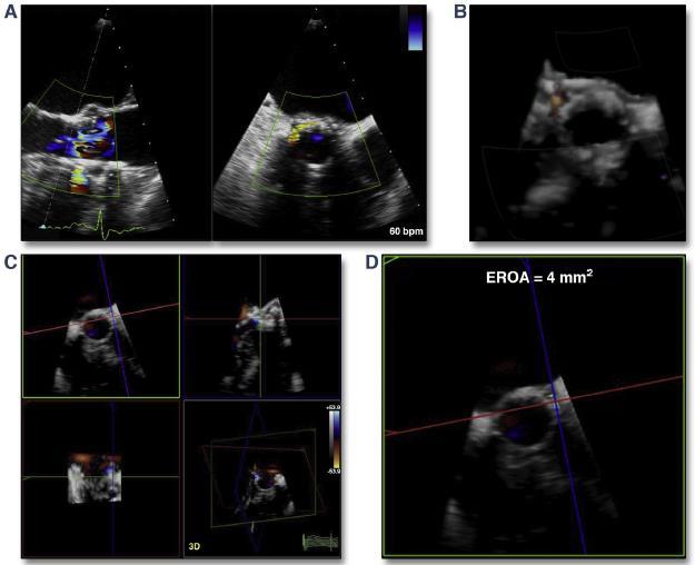 3-D Echocardiography for PVL