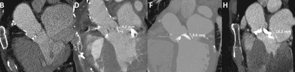 Extension of calcifications to