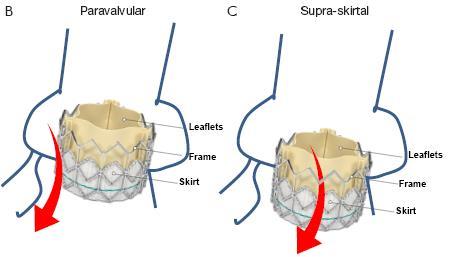 Mechanism of Paravalvular Regurgitation (II) Prosthesis too small