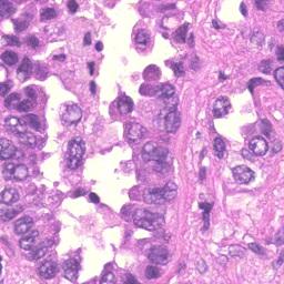 squamous cell carcinoma (LUSC).