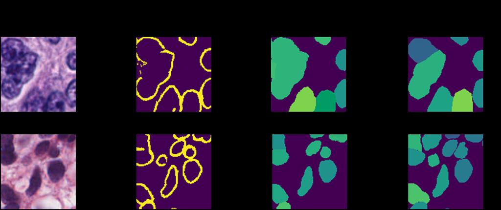 FIGURE 9: Examples of correct and incorrect nuclei segmentation.