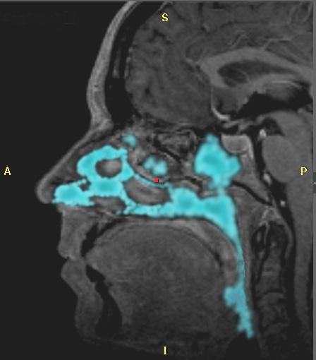 Advantages of Endoscopic Approaches to Anterior Skull Base