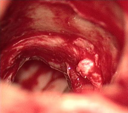 Left internal carotid artery sheath uncovered in lateral