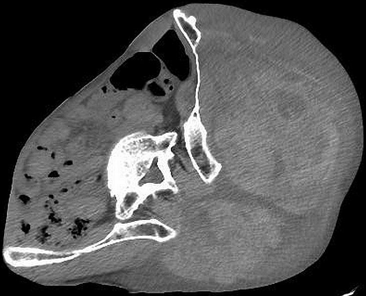 26 T. Ueno et al. / JPRAS Open 5 (2015) 24e28 Figure 2. Plain CT showing a large, hyperdense subcutaneous soft-tissue mass on the buttock measuring 23 12 24 cm. Figure 3.