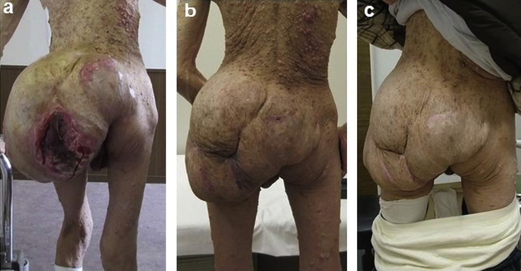 T. Ueno et al. / JPRAS Open 5 (2015) 24e28 27 Figure 4. Appearance of the hematoma, which gradually reduced in size. a) Two weeks after admission.