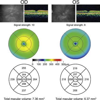 Optical coherence tomography in the evaluation of NF-1 subjects with optic pathway gliomas. J AAPOS. 2010 Dec;14(6):511-7.
