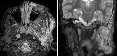 Infiltrating Plexiform Neurofibroma on MRI