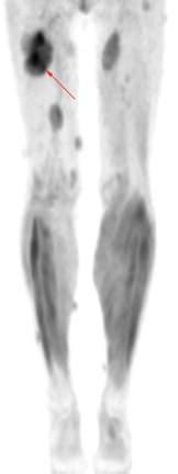 PET SCAN of PLEXIFORM NEUROFIBROMA Coronal Whole body