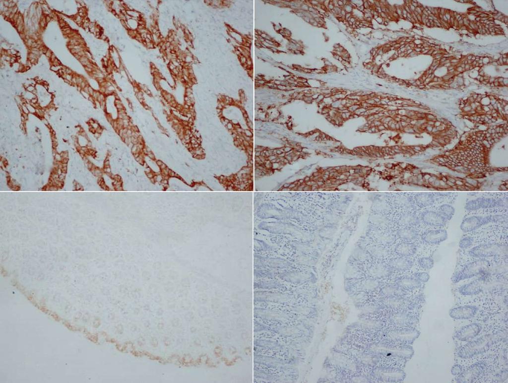 Wu QB et al. COX-2 and HER-2 in colorectal cancer A B 50 mm 50 mm C D 100 mm 100 mm Figure 1 Immunohistochemical staining of COX-2 and HER-2 in colorectal cancer and normal colorectal tissue.