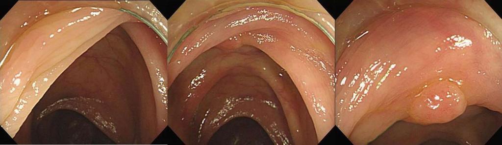 Kim DJ et al. Efficacy of cap-assisted colonoscopy Figure 2 Images of cap-assisted colonoscopy. A lesion was located in the proximal aspect of a haustral fold.