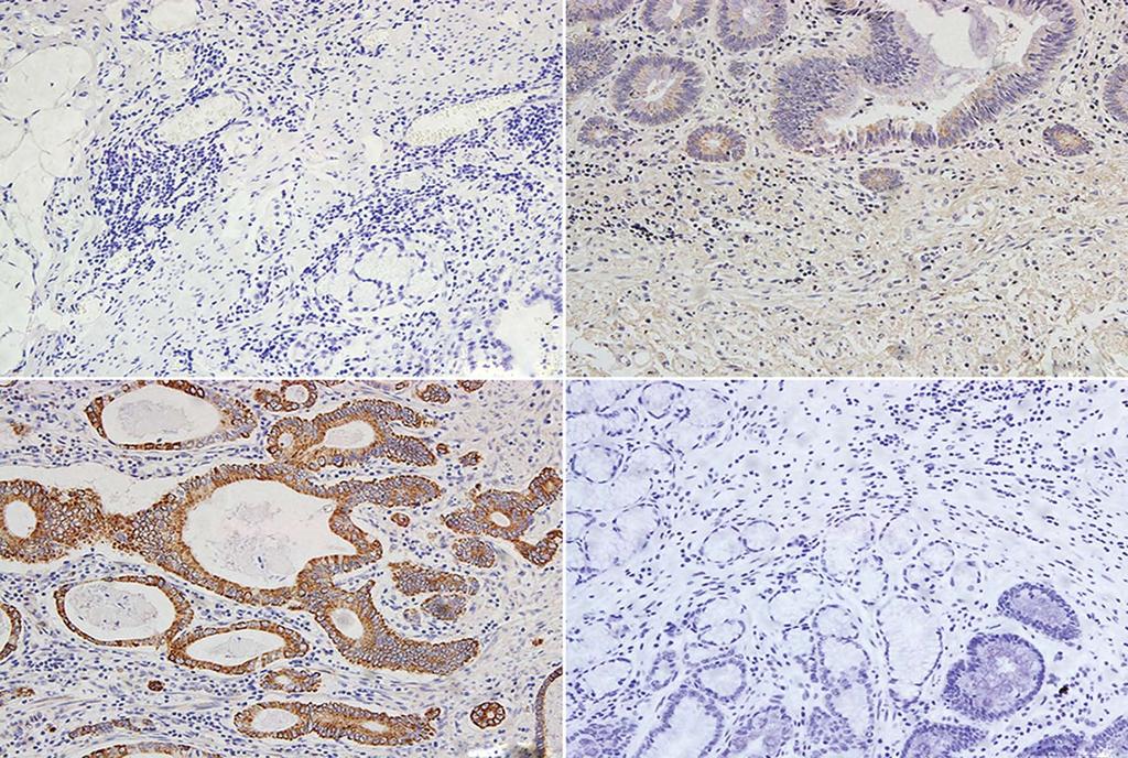 Wang P et al. NOX2 and gastric cancer A B 100 mm 100 mm C D 100 mm 100 mm Figure 1 Immunohistochemical staining results for NADPH oxidase 2.