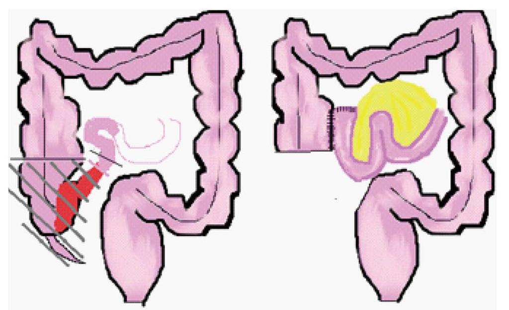 Baillie CT et al. Surgical strategies in paediatric IBD Figure 3 Ileocaecal resection for terminal ileal Crohn s disease.