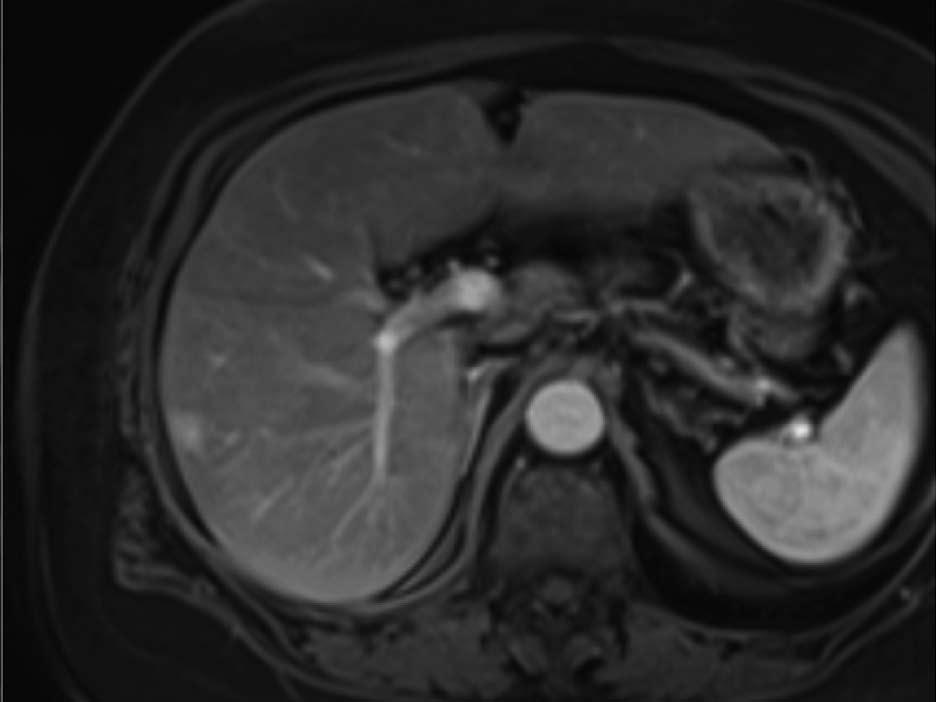 Coronal (A, B) and transversal (C-F) T1w contrast-enhanced MRI images