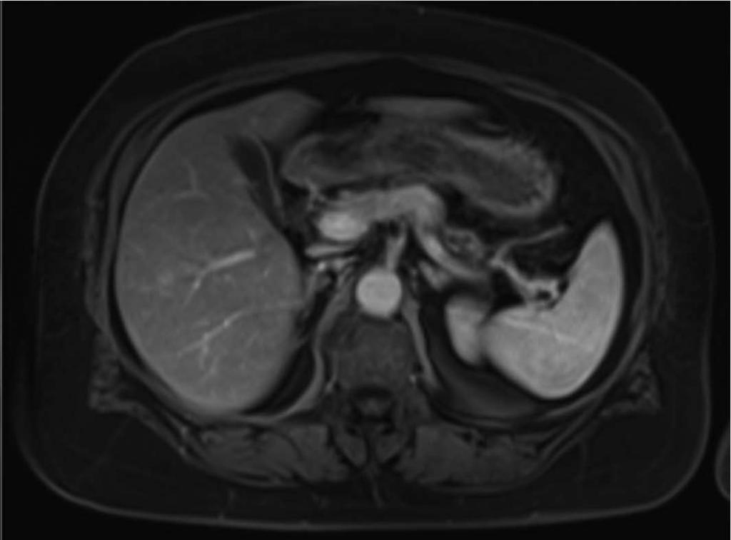 and regredient hepatic metastases (arrow, cycle) in the right liver lobe (A, B,