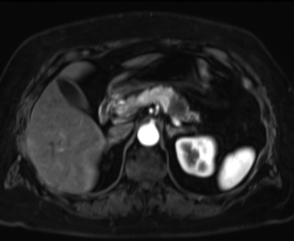 CT scan showed metastases in a retroperitoneal lymph node and muscles of the